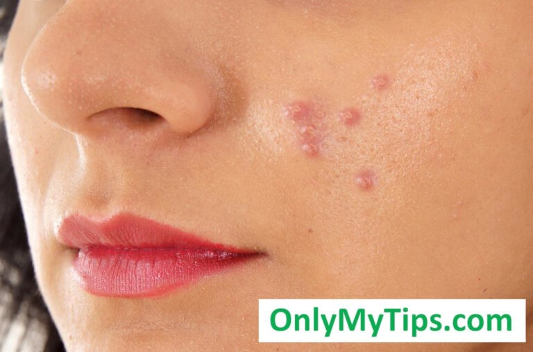 pimples tips