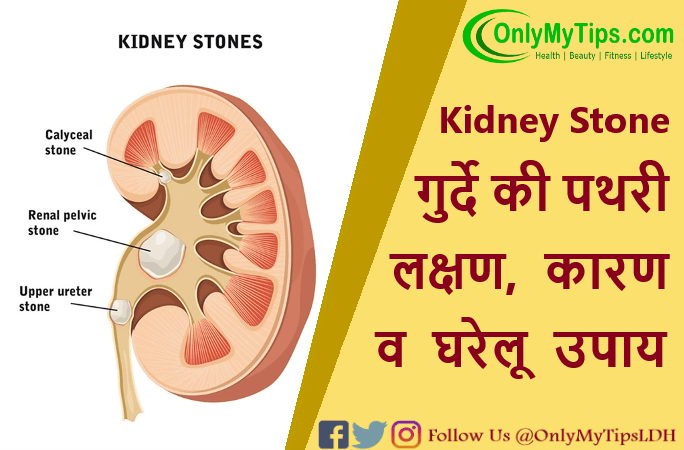 kidney-stone-home-remedies.png